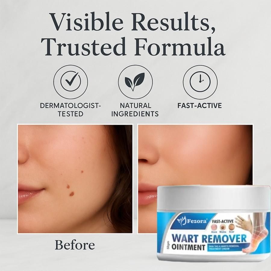 This pharmaceutical-grade 50gm wart removal cream employs advanced dermatological compounds to effectively target and eliminate common and plantar warts. The precision-formulated solution penetrates wart tissue to disrupt cellular structure while preserving surrounding healthy skin. With consistent application as directed, patients can expect gradual reduction in wart size and eventual complete resolution without surgical intervention.
