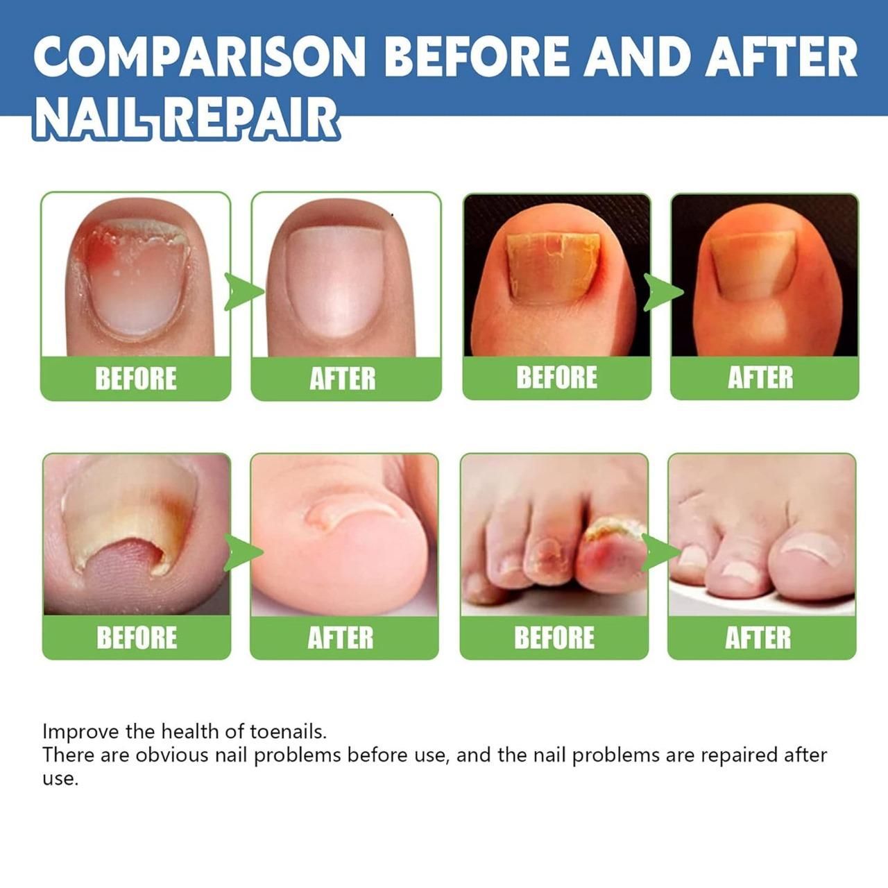 This professional-grade Nail Fungus Treatment Cream delivers targeted therapy for fungal nail infections. Each pack contains two 100gm tubes of our proprietary formula designed to eliminate pathogens while strengthening nail structure. The concentrated active ingredients penetrate the nail bed to address infection at its source, helping to reduce discoloration, brittleness, and thickness. Dermatologically tested and developed based on clinical research to provide effective, long-lasting relief from nail fun