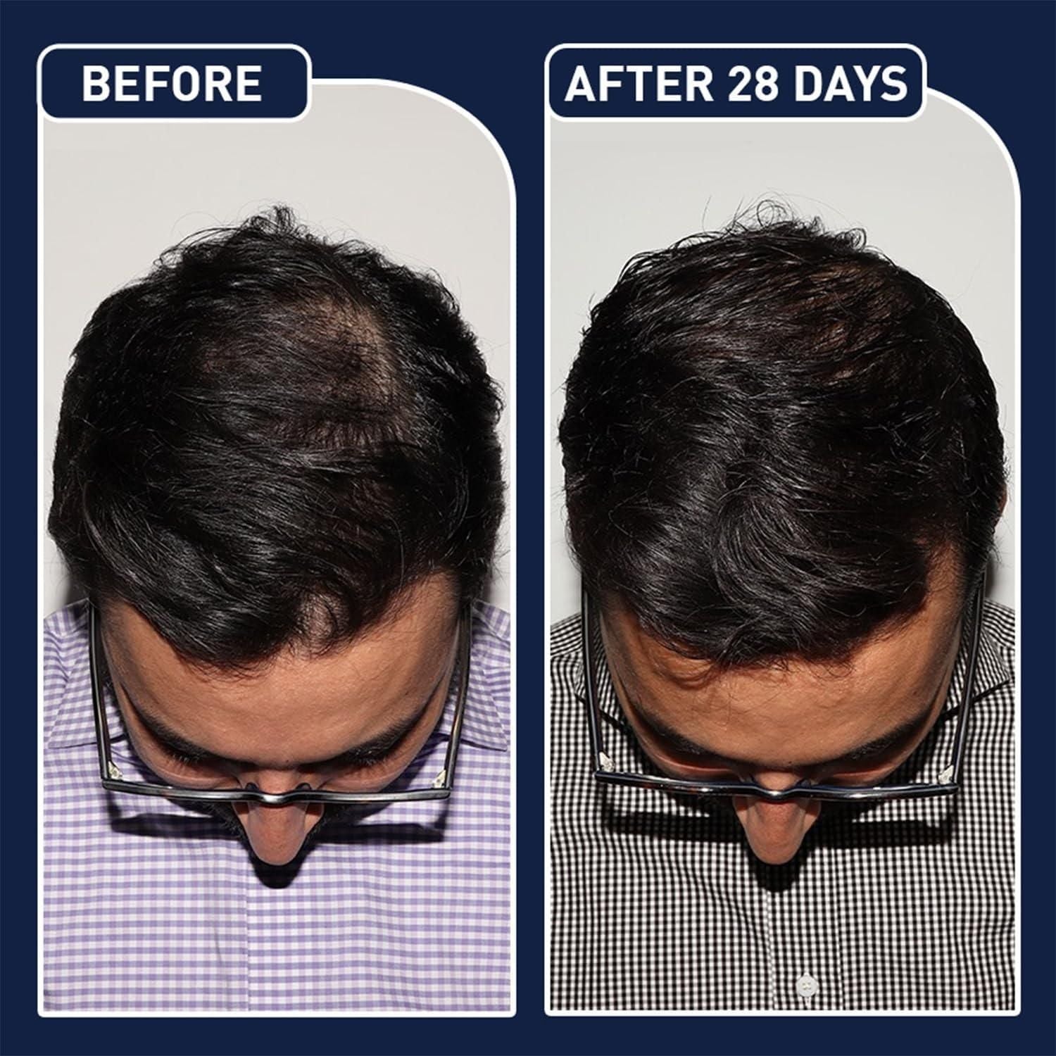 EFGPLUS Hair Growth Spray delivers concentrated follicular nourishment in a precise 50ml formula. This specialized solution utilizes advanced compounds to stimulate dormant hair follicles, enhance microcirculation, and strengthen the hair shaft from root to tip. Clinically developed to address pattern thinning while supporting natural growth cycles for measurably improved density and vitality.
