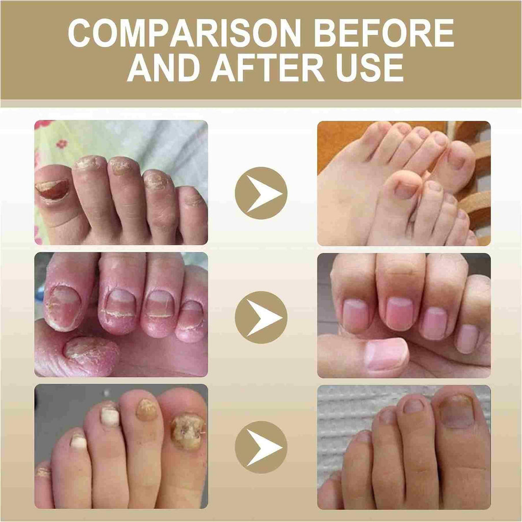 Zidella Herbal Nail Nourishing Essence combines botanical extracts in a potent 30ml formula, available in a value pack of two bottles. This professional-grade treatment targets nail weakness, brittleness, and discoloration by delivering essential nutrients directly to the nail matrix. The concentrated herbal complex works to strengthen keratin structure, enhance moisture retention, and stimulate healthy nail growth for visibly improved appearance and condition.