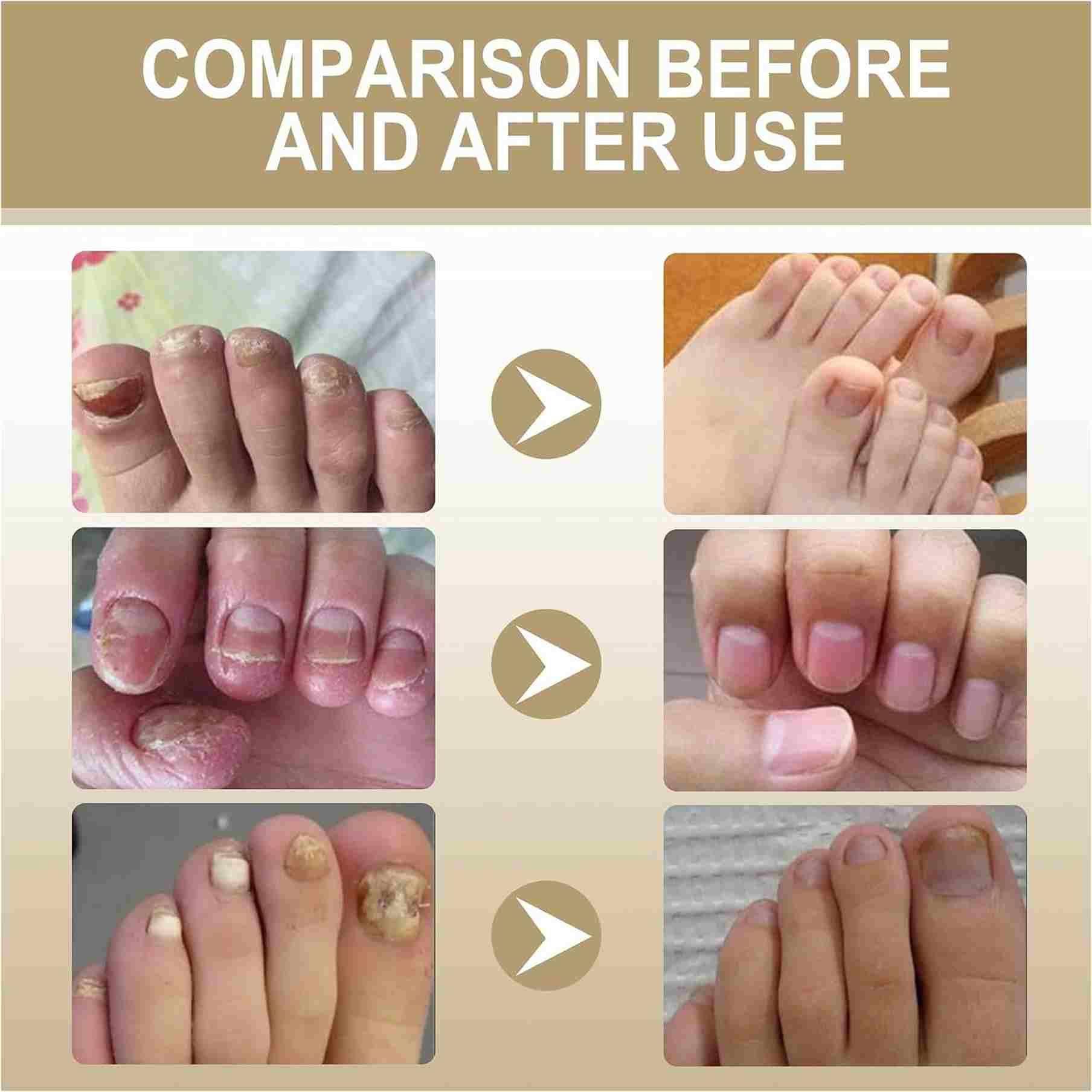 Zidella Herbal Nail Nourishing Essence combines botanical extracts in a potent 30ml formula, available in a value pack of two bottles. This professional-grade treatment targets nail weakness, brittleness, and discoloration by delivering essential nutrients directly to the nail matrix. The concentrated herbal complex works to strengthen keratin structure, enhance moisture retention, and stimulate healthy nail growth for visibly improved appearance and condition.