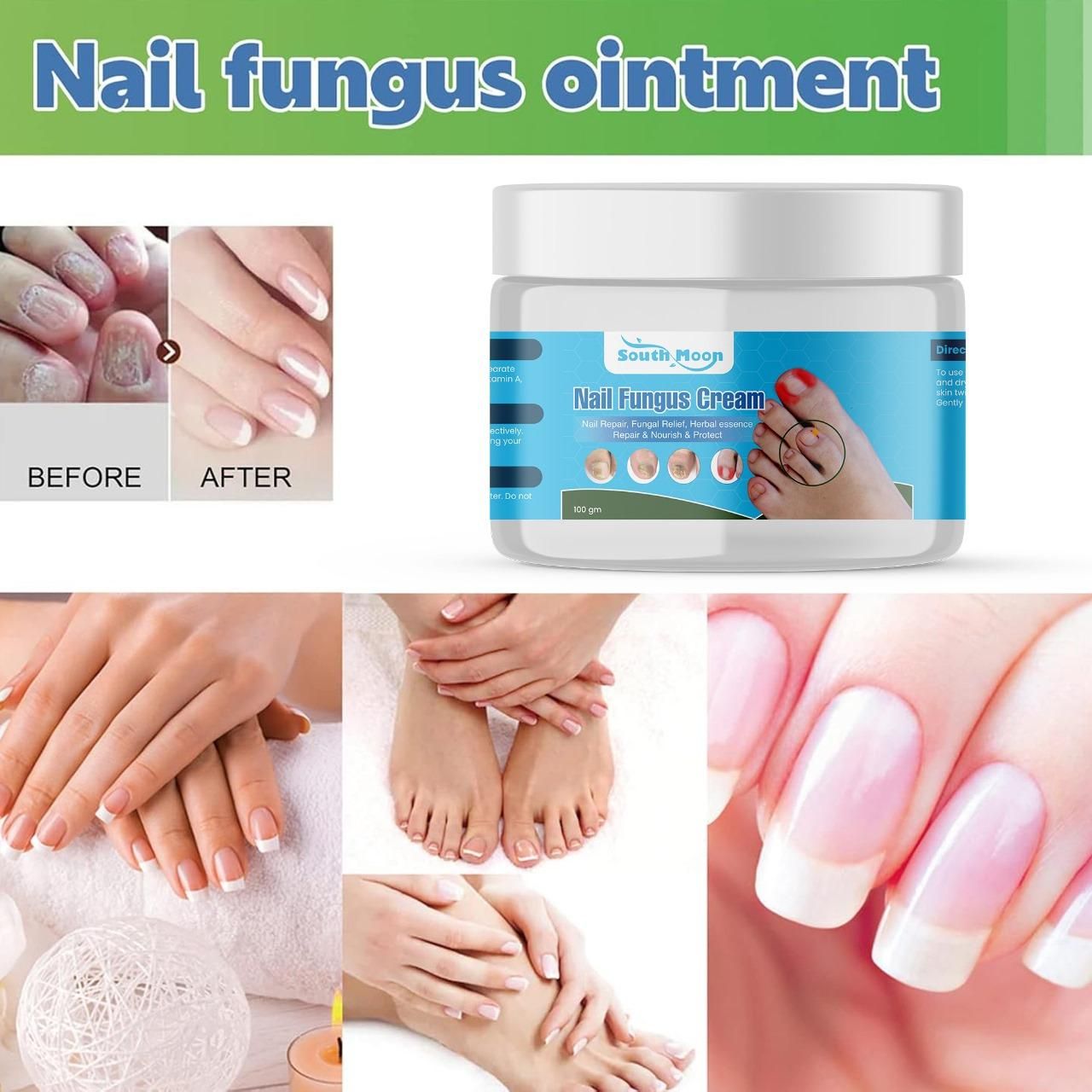 This professional-grade Nail Fungus Treatment Cream delivers targeted therapy for fungal nail infections. Each pack contains two 100gm tubes of our proprietary formula designed to eliminate pathogens while strengthening nail structure. The concentrated active ingredients penetrate the nail bed to address infection at its source, helping to reduce discoloration, brittleness, and thickness. Dermatologically tested and developed based on clinical research to provide effective, long-lasting relief from nail fun