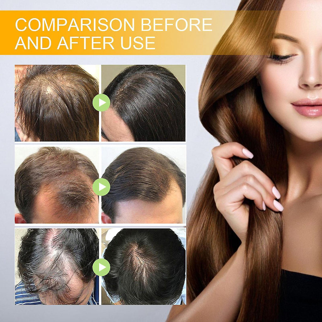 This clinically-developed biotin hair growth spray combines potent herbal extracts and essential oils to target thinning areas and stimulate follicle activity. The advanced serum formulation penetrates deeply to nourish the scalp, strengthen hair structure, and accelerate growth cycles. This dual-pack system provides a comprehensive approach to hair restoration, with visible results when used consistently as part of a professional hair care regimen.
