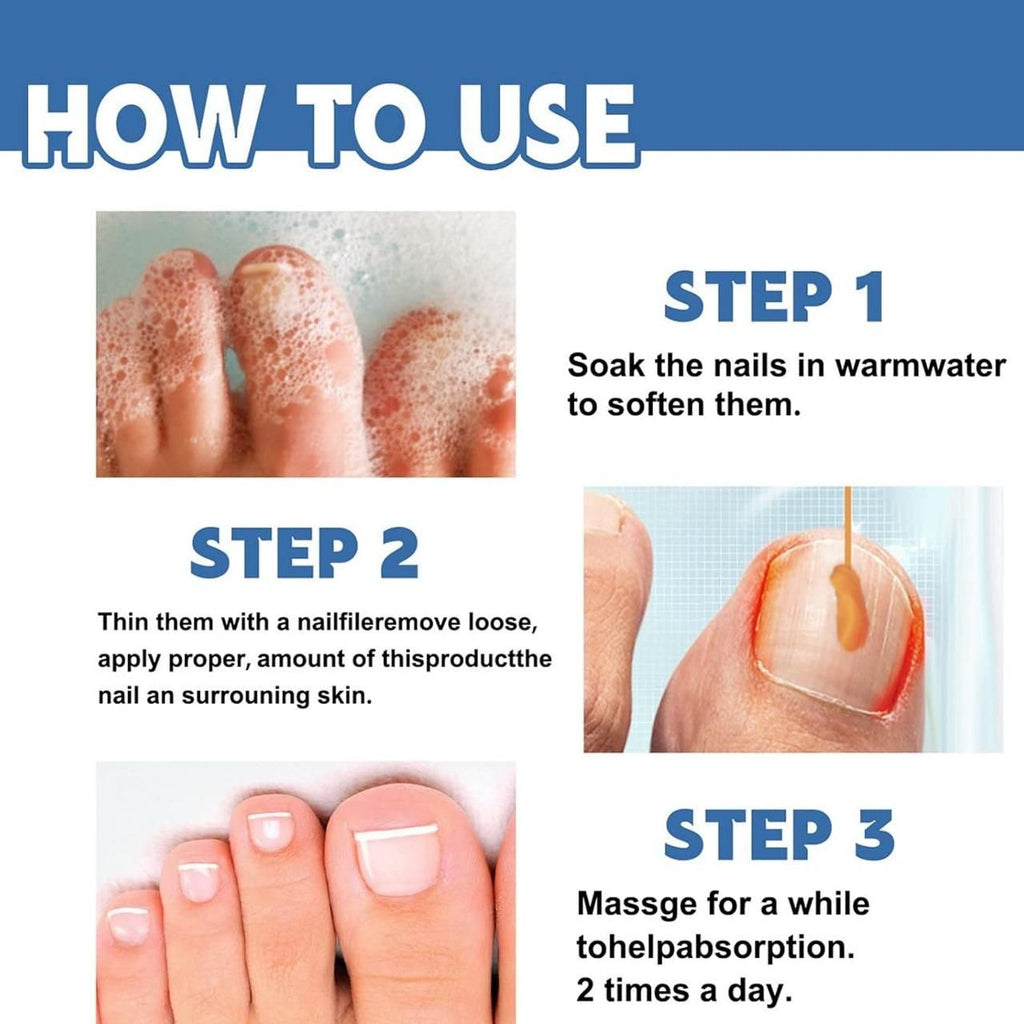 This professional-grade Nail Fungus Treatment Cream delivers targeted therapy for fungal nail infections. Each pack contains two 100gm tubes of our proprietary formula designed to eliminate pathogens while strengthening nail structure. The concentrated active ingredients penetrate the nail bed to address infection at its source, helping to reduce discoloration, brittleness, and thickness. Dermatologically tested and developed based on clinical research to provide effective, long-lasting relief from nail fun