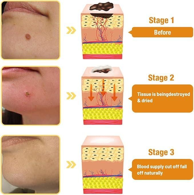 This advanced Bee Venom Wart & Mole Removal Cream harnesses the bioactive properties of bee venom to target and diminish unwanted skin growths. The proprietary formula works by stimulating local circulation and promoting natural exfoliation of affected tissue. Each dual pack provides sufficient product for complete treatment cycles, allowing for consistent application until desired results are achieved. Dermatologically tested for safety while maintaining efficacy on various skin types.