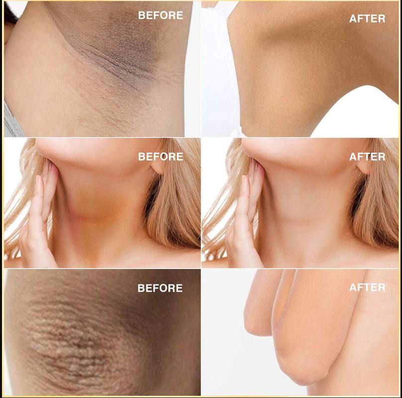 KURAIY Advanced Under-Arm Whitening Cream effectively targets underarm discoloration with its specialized formula. This 50-gram pack delivers professional-grade results by addressing hyperpigmentation while simultaneously nourishing sensitive underarm skin. Formulated to provide gradual, natural-looking results with consistent application.
