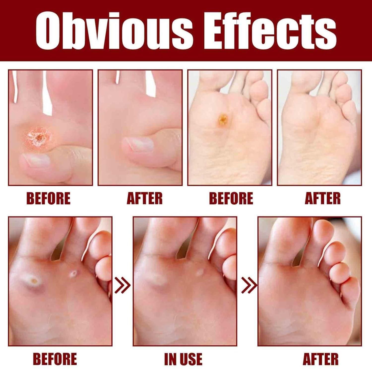 This clinically-formulated Feet Corn Removal Serum (30ml) targets and dissolves painful foot corns with precision. The concentrated solution penetrates hardened skin layers to break down keratin buildup while preserving healthy tissue. Formulated with active ingredients that soften, exfoliate, and repair, this professional-grade treatment offers a non-invasive alternative to surgical corn removal, delivering visible results with consistent application.